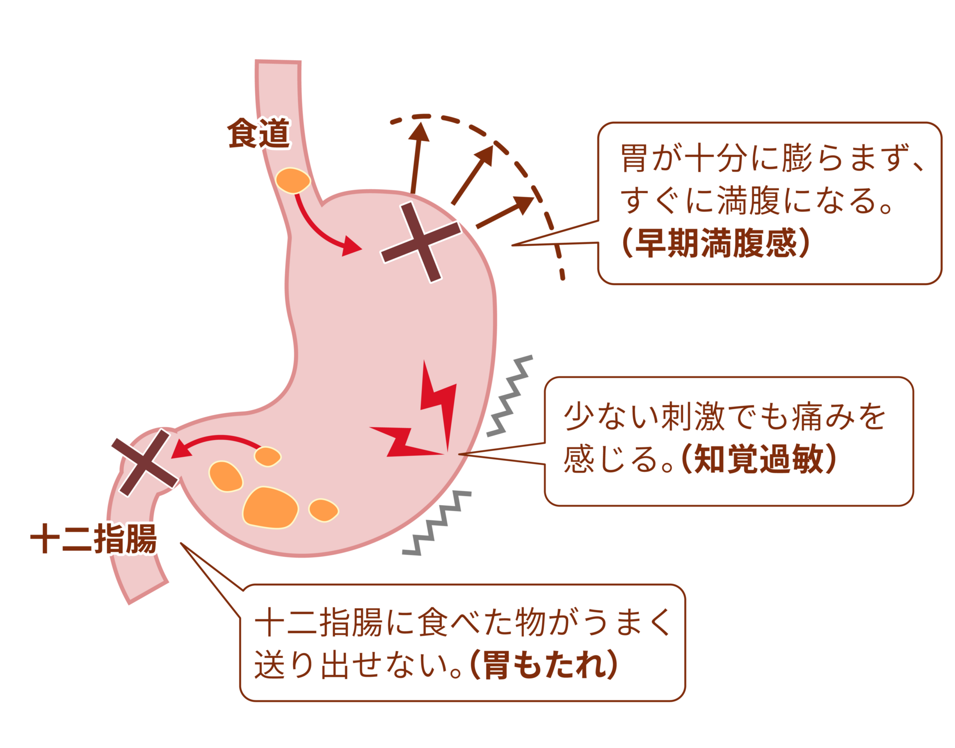 【画像】機能性ディスペプシア(FD)の症状と仕組みの説明図